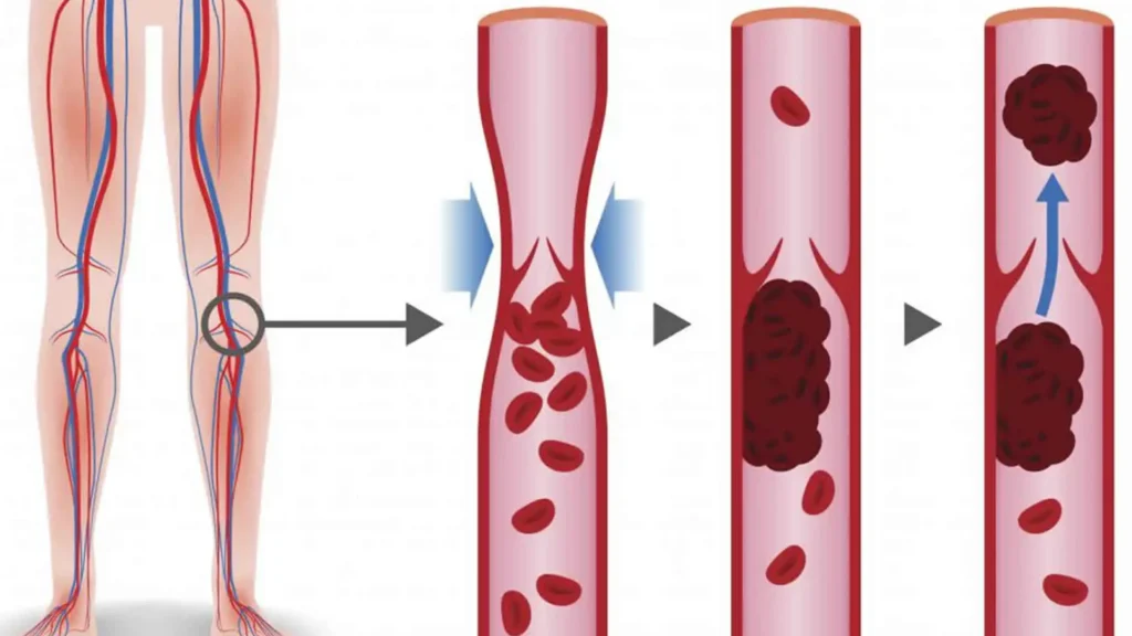 Ilustração médica mostrando a formação de um coágulo em uma veia da perna, causando trombose do viajante.